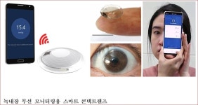 녹내장 진단용 안압 모니터링 콘택트렌즈 개발