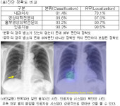  인공지능, 폐암 포함 주요 4대 흉부질환 모두 진단  