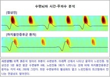 하지불안증후군 환자의 숙면 어려웠던 원인은?…‘수면방추, 느린진동 저하와 불균형’