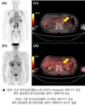 PET/CT로 B세포 림프종 CD20 단백질 발현 여부 진단 임상시험 진행