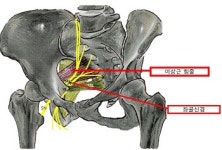 좌골신경통 원인, 허리디스크 아닌 ‘이상근 증후군’도 의심해야