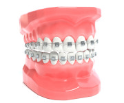 예쁜 미소를 위한 치아교정 종류 및 교정시 고통은?