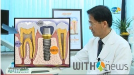 [위드인 닥터] 임플란트의 장기적 안정성 유지에 제일 중요한 요소