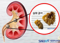 여름철 ‘요로결석’ 주의…수분 섭취 줄어들면 발생률 증가