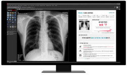 프로메디우스, 흉부 X선 기반 ‘골다공증 선별 AI 솔루션’ 혁신의료기기 지정