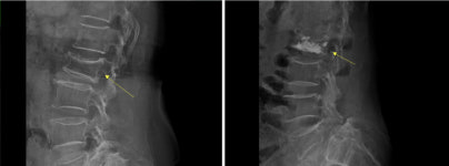 허리 통증 계속된다면? 척추 압박골절 의심… 치료 서두르세요
