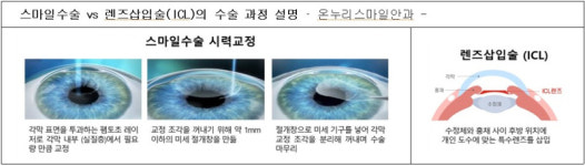 (주)서울레이저 인돈식 | 양대 시력교정술…‘스마일라식 vs 렌즈삽입수술’ 만족도는?