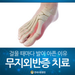 [연세사랑병원 줄기세포연구실 정형외과 칼럼] 무지외반증 치료, 걸을 때마다 발이 아픈 이유