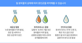 [약 이야기]질염 약은 자기 전 사용하고 질 세정제는 주 2회 이하