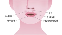 입 주위 발진·뾰루지, 피로가 아닌 세균 감염 때문? 