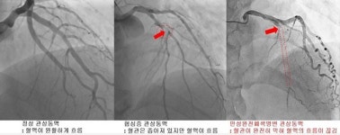 심장 혈관 완전히 막혔어도 약으로 치료 가능