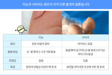 [약 이야기]사마귀 치료제, 티눈에 발랐다간 피부 손상, 광과민증으로 고생해요