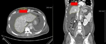 [칼럼] 간경화, 맞춤형 자가 줄기세포 시술로 간이식 수술 부담 벗어나