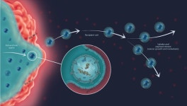 SOL Bio develops exosome diagnostic tech to detect prostate cancer