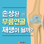 [카드뉴스] 손상된 무릎연골 재생이 될까?