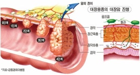직장암, 전이·재발·수술 합병증이 잦은 까닭은?