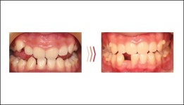 [특집] 시스루테크 ‘시스루 얼라이너’