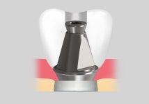 접착제 필요없는 ‘장구’형 어버트먼트에 주목