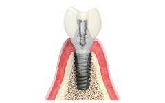 시멘트리스 보철 ‘SAFE FIT’ 안정성·효율성 각광