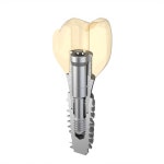 임플란트 고민? ‘유한 트윈제로’로 한방에 해결!