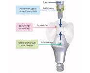 한큐플란트, 신개념 SCRP 시멘트리스 보철 출시