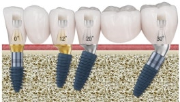 [HOT PRODUCT] 메가젠임플란트 AXA Abutment