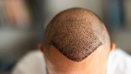 탈모, 멈출 수 있을까?