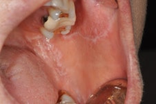 아프고 성가신 입안 염증 구내염