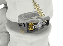 시지메드텍, 척추 임플란트 ‘유니스페이스’ 美FDA 승인