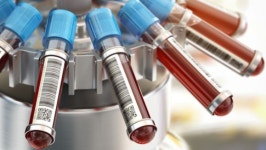 혈액검사로 20여종 암 진단하는 시대 열린다