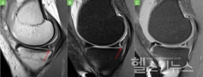 [이상학 교수의 건강칼럼] 전방십자인대파열 환자, 10명 중 2~3명은 램프병변 함께 발생