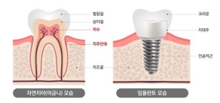 자연치아, 임플란트보다 기능적으로 우수 … 보존치료 우선해야