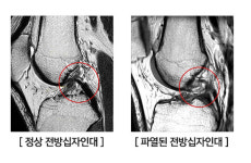 2030 무릎 전방십자인대파열 증가세 … 무리한 운동 탓