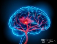 치매예방약이 뇌졸중 위험 높인다?