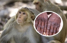 원숭이두창, 증상·원인·관련주... 키메릭스·이머전트 바이오솔루션스·시가테크놀러지 훨훨