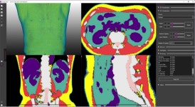 메디컬아이피, AI 기반 체성분 지표 활용... 대사질환 조기진단, 예후 예측 가능해졌다!