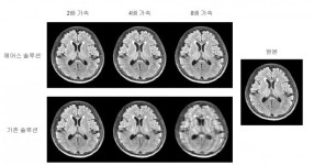 MRI 촬영시간 4분의 1로 줄였다