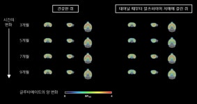 알츠하이머 치매 PET로 조기 판별 방법 나왔다