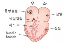 폐경 후 심방세동, 스트레스와 불면증 때문?