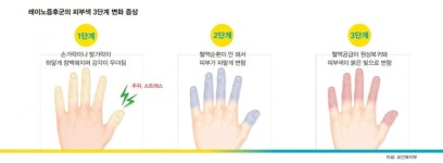 수족냉증 방치하다 레이노증후군 키운다
