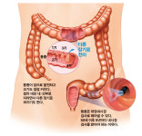 대변이 대장암을 대변한다
