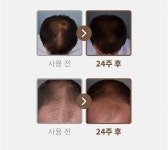 [인터뷰] 헤세드 바이오, 림스 테크놀로지 통한 안드로겐성 탈모 완화∙치료 물질 연구∙개발