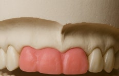 [V헬스] 임플란트 완성도 높이는 치료 계획은?