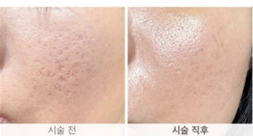 아이에이치의원, 여드름 흉터 제거 SDR 시술 상표권 출원