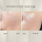 아이에이치의원, 레이저로 안되던 여드름 흉터 치료 SDR 시술 개발