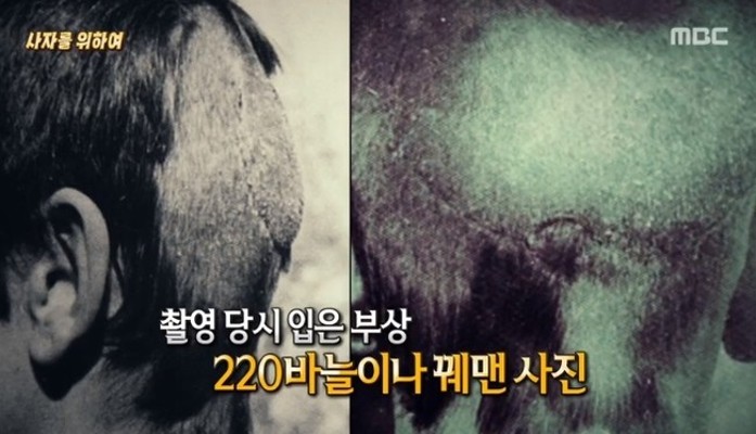 공포영화보다 무서운 ‘로어’ 촬영 중 뒤통수 220바늘 꿰맨 사연(서프라이즈) | 포토뉴스