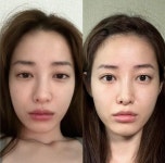 돌싱 유깻잎 “눈 코 무슨 일” 얼굴 지방이식에도 부기는 남달라
