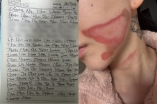 권민아, 피부과 시술 받고 2도 화상 입었는데…“난 마취 크림 부작용 있어” 해명