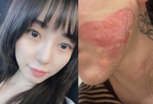 권민아, 피부과 시술 부작용으로 화상 입은 심경 “지은 죄가 너무 많은 걸까”