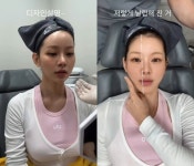 맹승지, 또 얼굴에 손댔다…의사 남친도 만족한 직접 시술 “평생 얼굴 해줄 것”